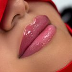 Russian Lips Before & After Patient #4391