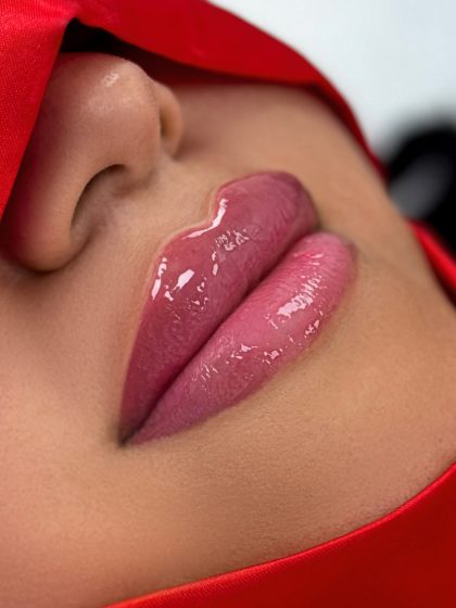Russian Lips Before & After Patient #4391