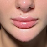 Chin Filler Before & After Patient #4228