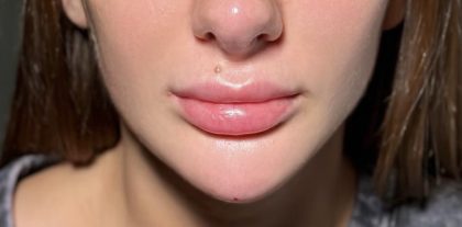 Chin Filler Before & After Patient #4228