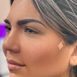 Fillers + Thread Lift Before & After Patient #4295