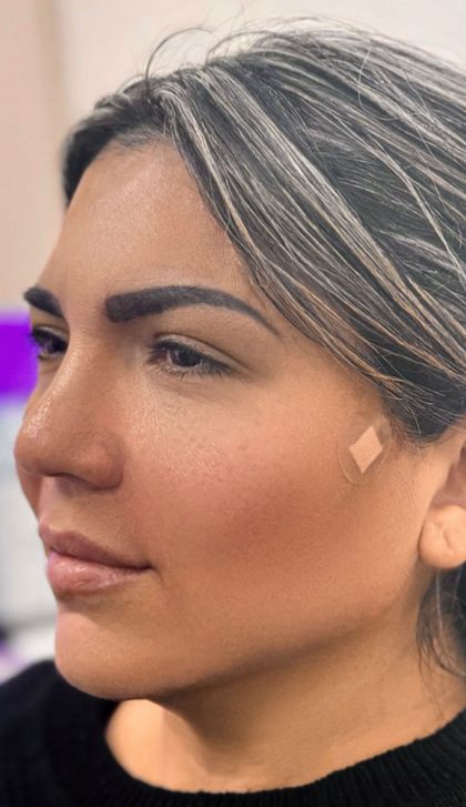 Fillers + Thread Lift Before & After Patient #4295