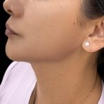 Jawline Filler Before & After Patient #4307