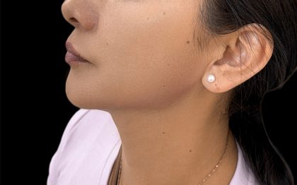 Jawline Filler Before & After Patient #4307