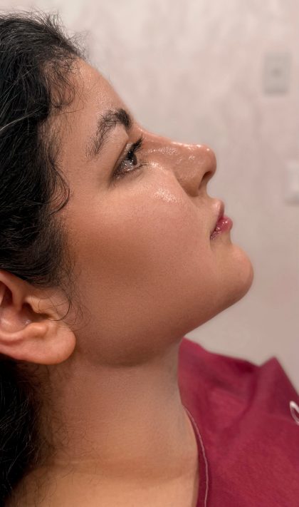 Chin Liposuction Before & After Patient #4237