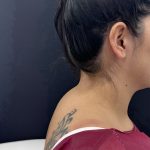 Buffalo Hump Removal Before & After Patient #4356