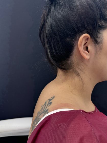 Buffalo Hump Removal Before & After Patient #4356