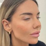 Fox Eye Threadlift Before & After Patient #4379