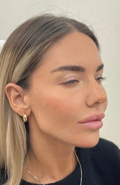 Fox Eye Threadlift Before & After Patient #4379