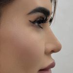 Liquid Rhinoplasty Before & After Patient #4382
