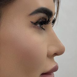 Liquid Rhinoplasty Before & After Patient #4382