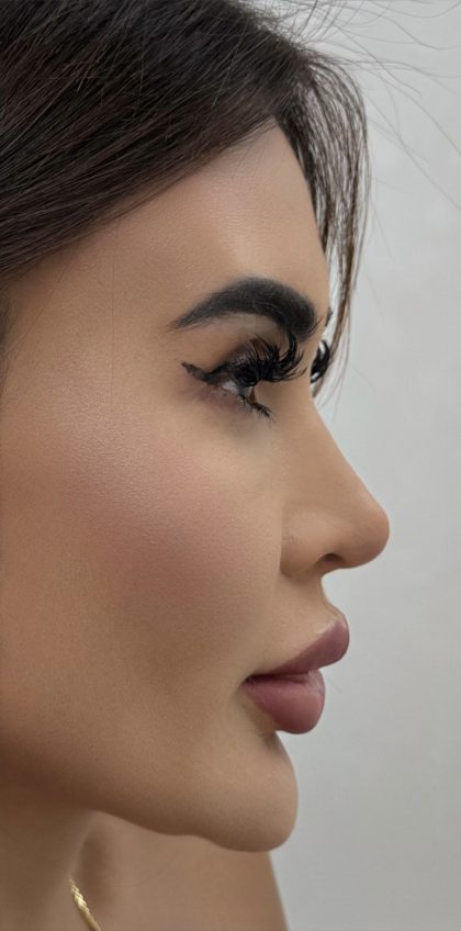 Liquid Rhinoplasty Before & After Patient #4382