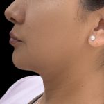 Jawline Filler Before & After Patient #4307