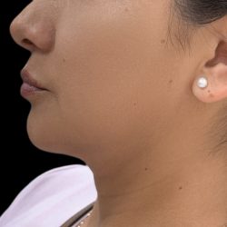 Jawline Filler Before & After Patient #4307