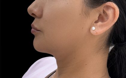 Jawline Filler Before & After Patient #4307