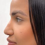 Facial Balancing With Fillers Before & After Patient #4280