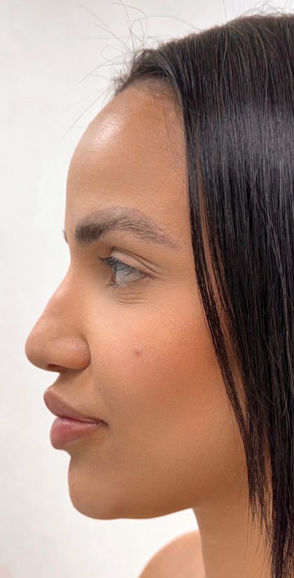 Facial Balancing With Fillers Before & After Patient #4280