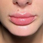 Chin Filler Before & After Patient #4228