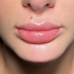 Chin Filler Before & After Patient #4228