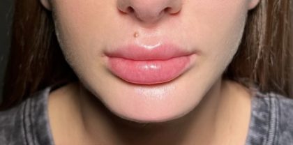 Chin Filler Before & After Patient #4228