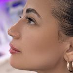 Facial Balancing With Fillers Before & After Patient #4362