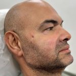 Fillers + Thread Lift Before & After Patient #4365