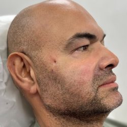 Fillers + Thread Lift Before & After Patient #4365