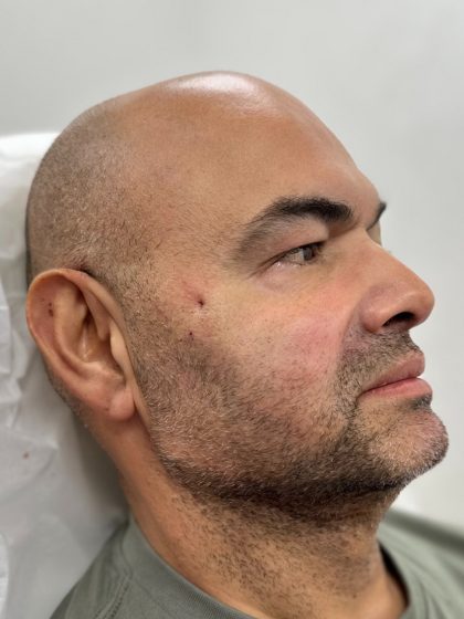 Fillers + Thread Lift Before & After Patient #4365