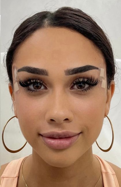 Fox Eye Threadlift Before & After Patient #4370