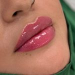 Russian Lips Before & After Patient #4394