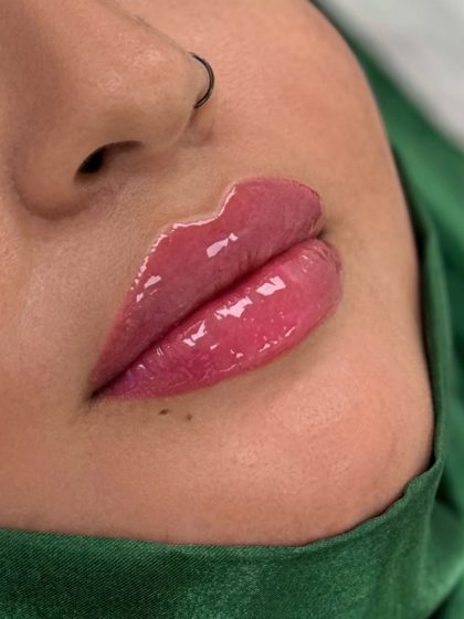 Russian Lips Before & After Patient #4394