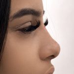 Liquid Rhinoplasty Before & After Patient #4316