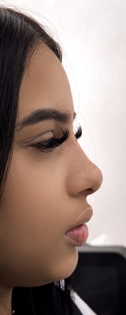 Liquid Rhinoplasty Before & After Patient #4316