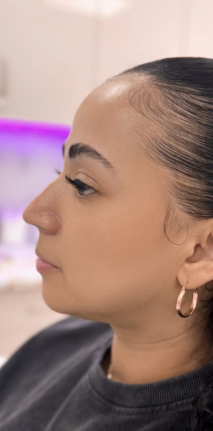 Facial Balancing With Fillers Before & After Patient #4362