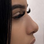 Liquid Rhinoplasty Before & After Patient #4316