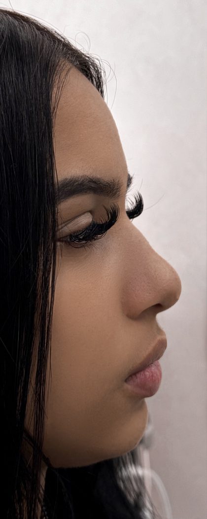 Liquid Rhinoplasty Before & After Patient #4316