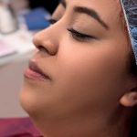 Chin Liposuction Before & After Patient #4240