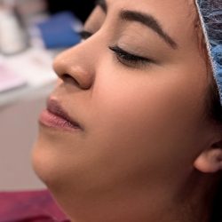 Chin Liposuction Before & After Patient #4240