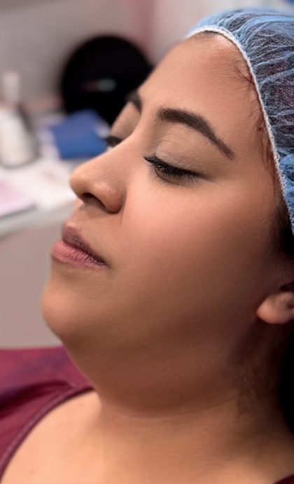 Chin Liposuction Before & After Patient #4240