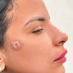Fillers + Thread Lift Before & After Patient #4298