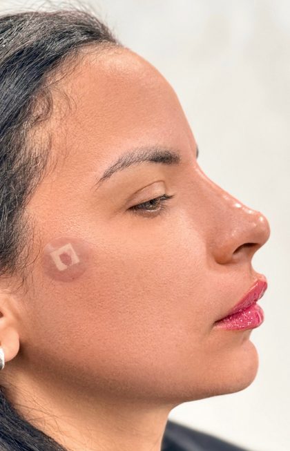 Fillers + Thread Lift Before & After Patient #4298