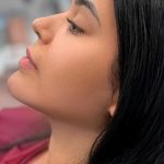 Chin Liposuction Before & After Patient #4243