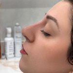 Liquid Rhinoplasty Before & After Patient #4319
