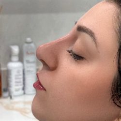 Liquid Rhinoplasty Before & After Patient #4319
