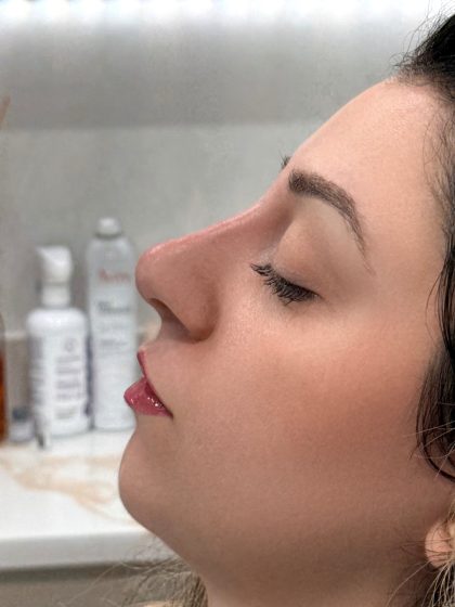Liquid Rhinoplasty Before & After Patient #4319