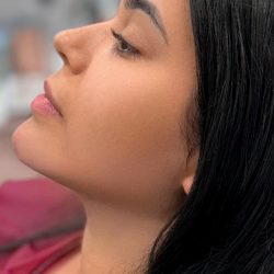 Chin Liposuction Before & After Patient #4243