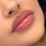 Russian Lips Before & After Patient #4334