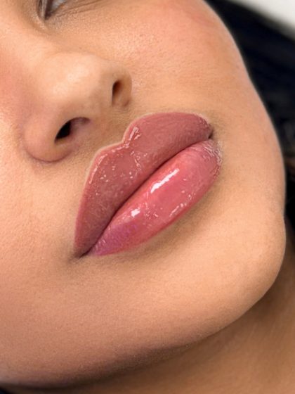 Russian Lips Before & After Patient #4334