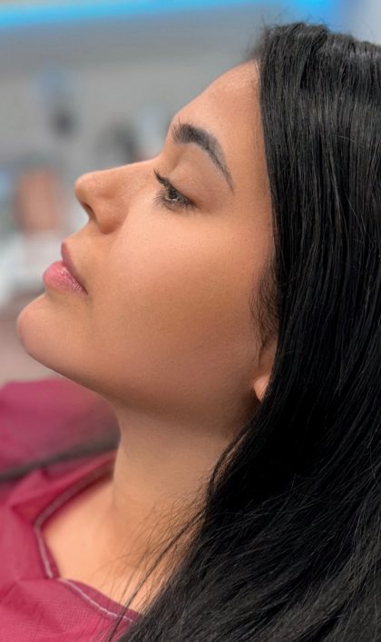 Chin Liposuction Before & After Patient #4243