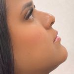 Facial Balancing With Fillers Before & After Patient #4283